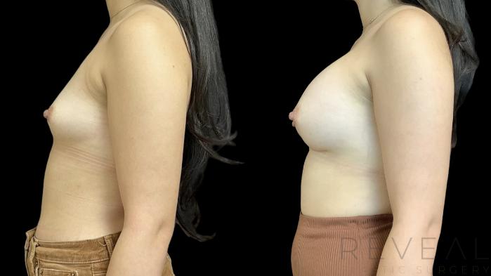 Before & After Breast Augmentation Case 761 Left Side View in San Jose, CA