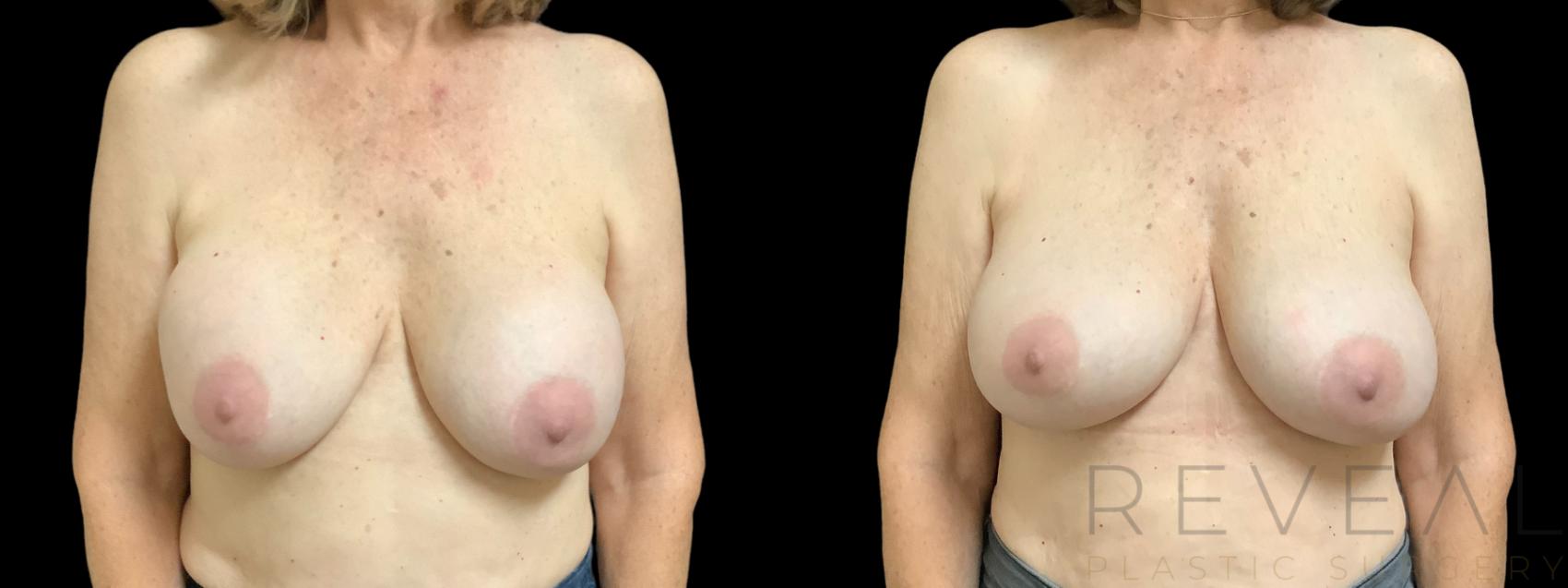 Before & After Breast Augmentation Case 762 Front View in San Jose, CA