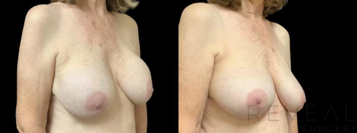 Before & After Breast Augmentation Case 762 Right Oblique View in San Jose, CA