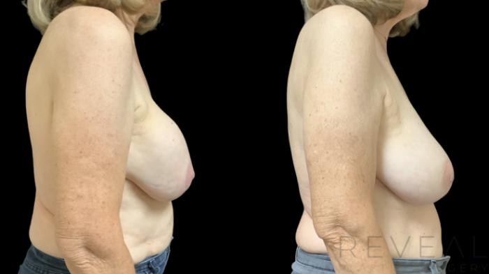 Before & After Breast Implants Case 762 Right Side View in San Jose, CA