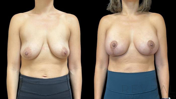 Before & After Breast Implants Case 763 Front View in San Jose, CA