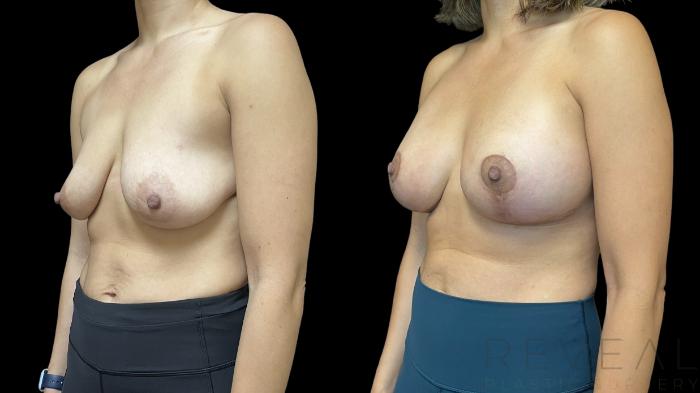 Before & After Breast Augmentation Case 763 Left Oblique View in San Jose, CA