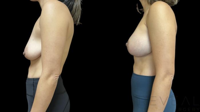 Before & After Breast Augmentation Case 763 Left Side View in San Jose, CA