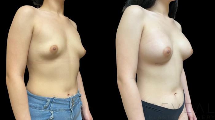 Before & After Breast Augmentation Case 768 Right Oblique View in San Jose, CA