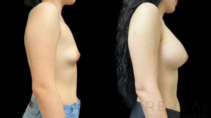 Before & After Breast Augmentation Case 768 Right Side View in San Jose, CA