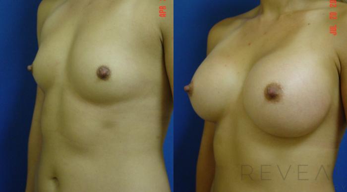 Before & After Breast Augmentation Case 77 View #3 View in San Jose, CA