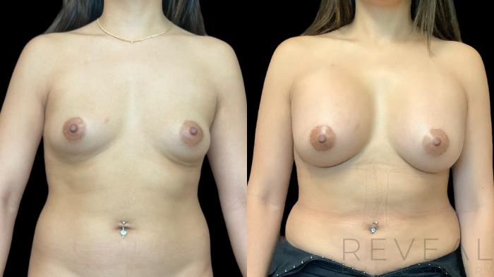 Before & After Breast Implants Case 774 Front View in San Jose, CA
