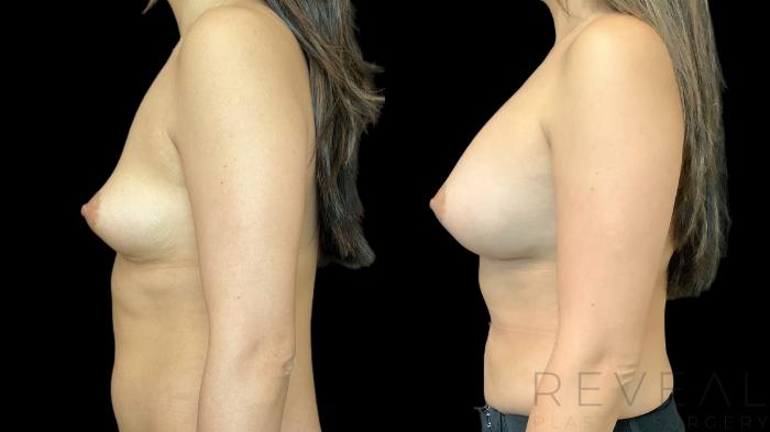 Before & After Breast Augmentation Case 774 Left Side View in San Jose, CA