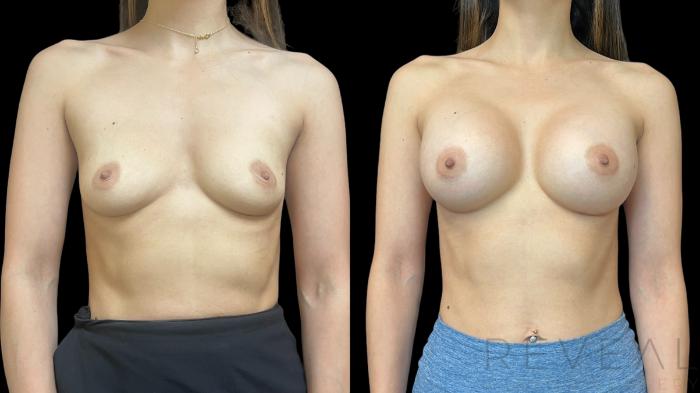 Before & After Breast Augmentation Case 784 Front View in San Jose, CA