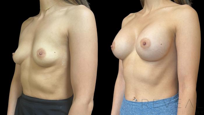 Before & After Breast Augmentation Case 784 Left Oblique View in San Jose, CA