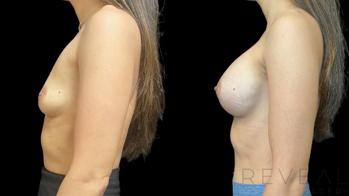 Before & After Breast Augmentation Case 784 Left Side View in San Jose, CA