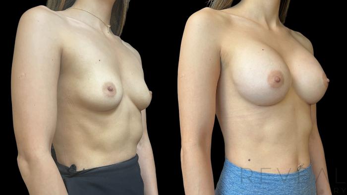 Before & After Breast Augmentation Case 784 Right Oblique View in San Jose, CA