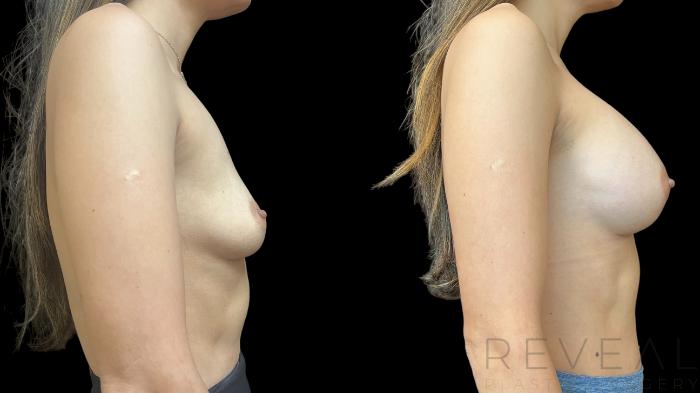 Before & After Breast Augmentation Case 784 Right Side View in San Jose, CA