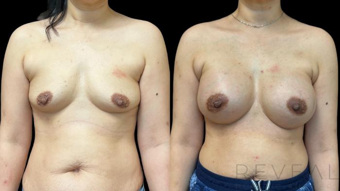 Before & After Breast Augmentation Case 785 Front View in San Jose, CA