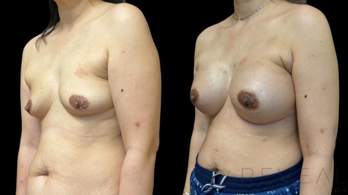 Before & After Breast Augmentation Case 785 Left Oblique View in San Jose, CA
