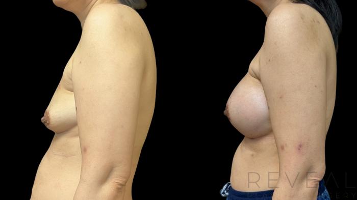 Before & After Breast Augmentation Case 785 Left Side View in San Jose, CA