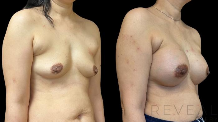 Before & After Breast Augmentation Case 785 Right Oblique View in San Jose, CA