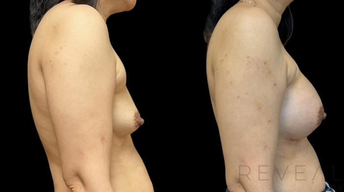 Before & After Breast Augmentation Case 785 Right Side View in San Jose, CA