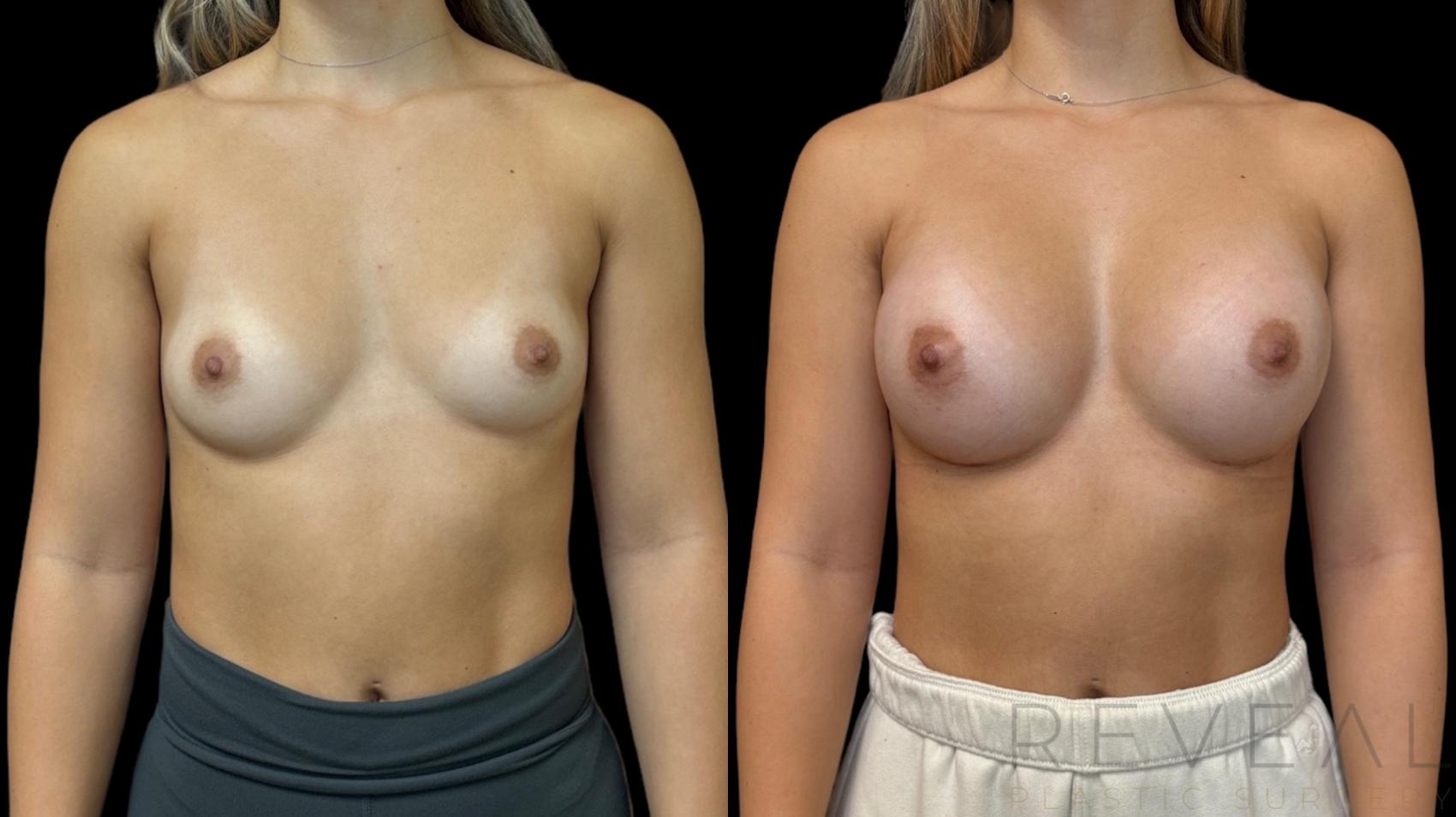 Before & After Breast Augmentation Case 786 Front View in San Jose, CA