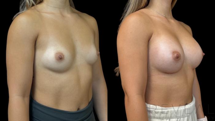 Before & After Breast Augmentation Case 786 Right Oblique View in San Jose, CA