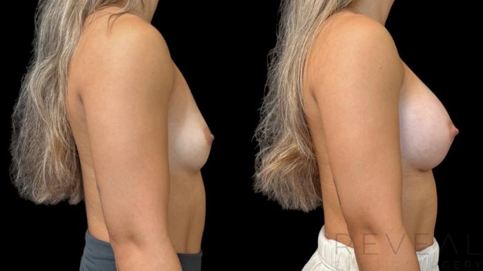Before & After Breast Augmentation Case 786 Right Side View in San Jose, CA