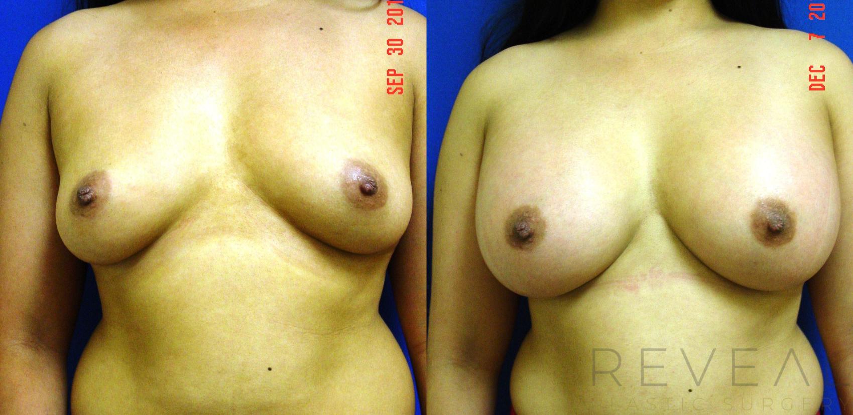 Before & After Breast Augmentation Case 80 View #1 View in San Jose, CA