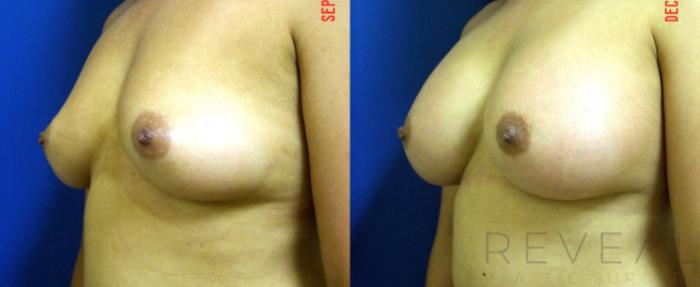 Before & After Breast Augmentation Case 80 View #2 View in San Jose, CA