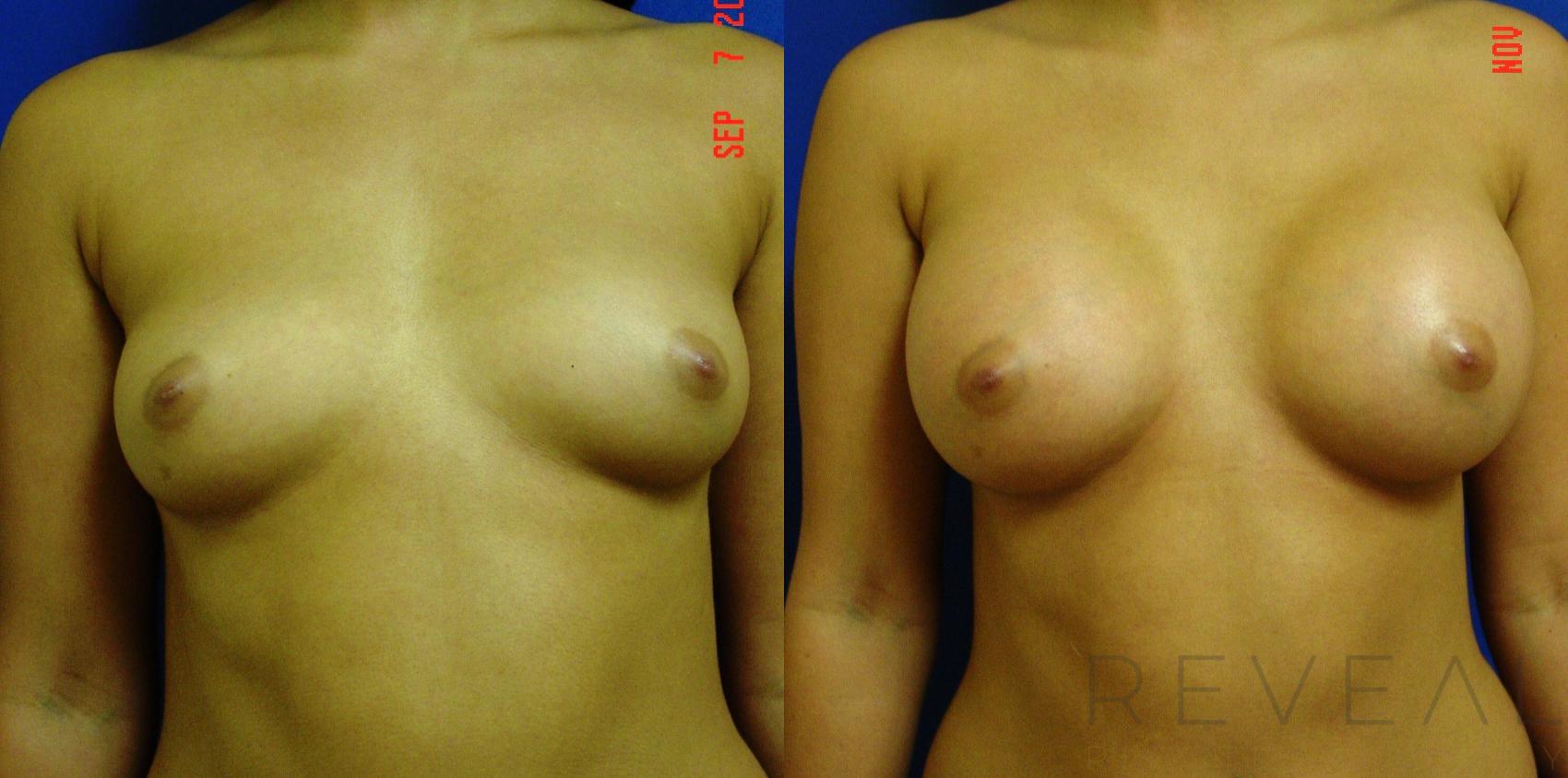 Before & After Breast Augmentation Case 81 View #1 View in San Jose, CA