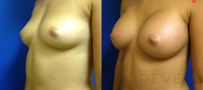Before & After Breast Augmentation Case 81 View #2 View in San Jose, CA