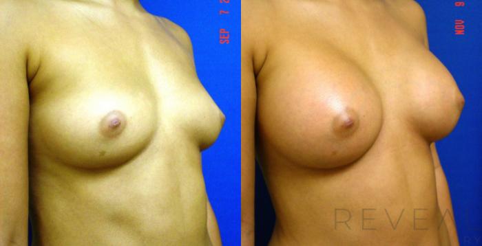 Before & After Breast Augmentation Case 81 View #3 View in San Jose, CA