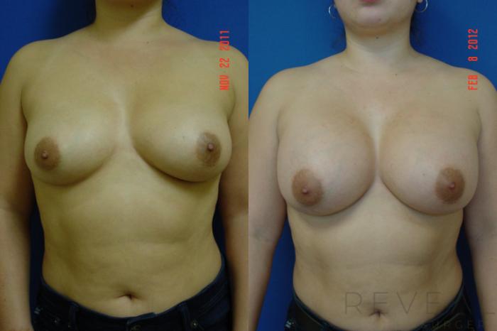 Before & After Breast Augmentation Case 83 View #1 View in San Jose, CA