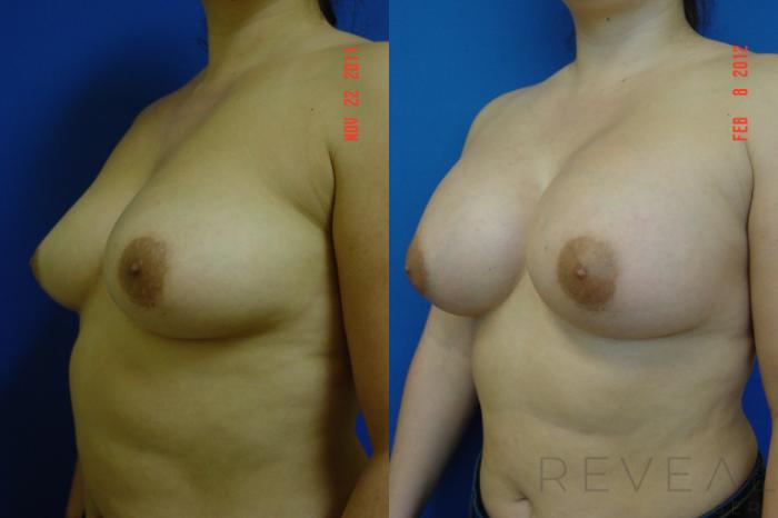 Before & After Breast Augmentation Case 83 View #2 View in San Jose, CA