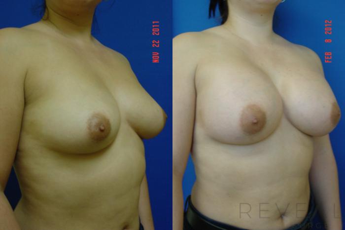 Before & After Breast Augmentation Case 83 View #3 View in San Jose, CA