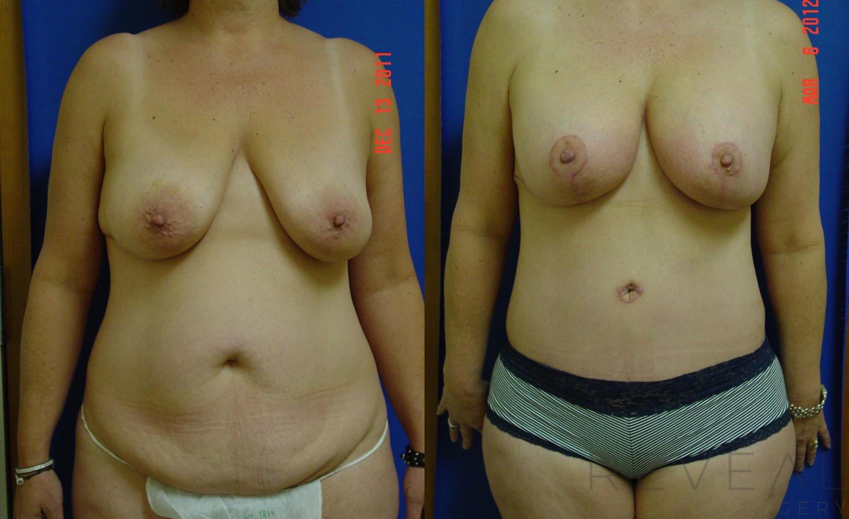 Before & After Liposuction Case 87 View #1 View in San Jose, CA