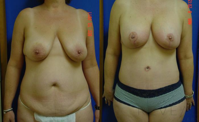 Before & After Breast Lift Case 87 View #1 View in San Jose, CA