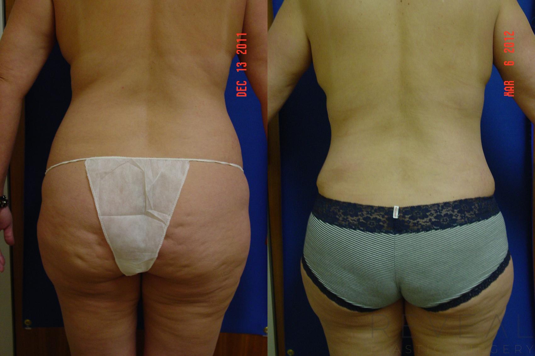 Before & After Liposuction Case 87 View #2 View in San Jose, CA
