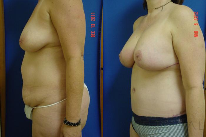 Before & After Tummy Tuck Case 87 View #3 View in San Jose, CA