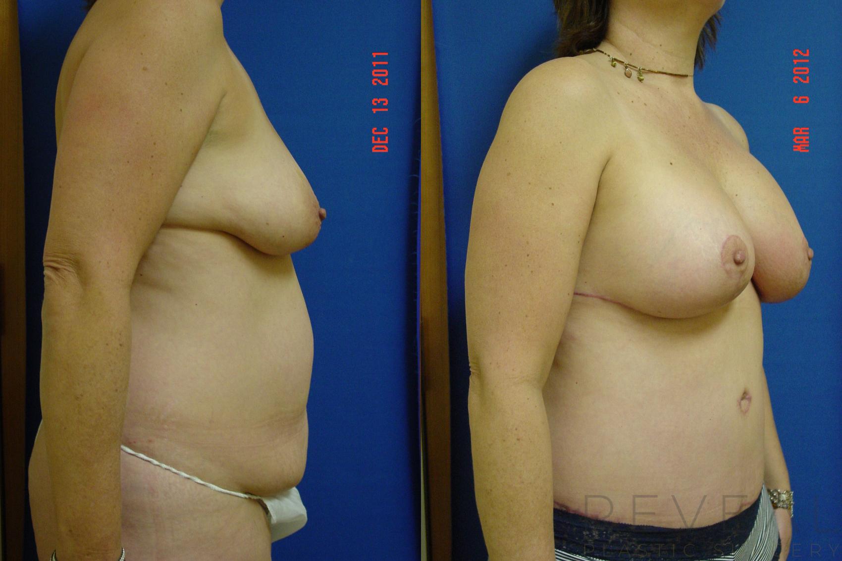 Before & After Liposuction Case 87 View #4 View in San Jose, CA
