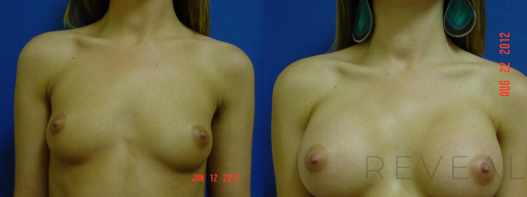Before & After Breast Augmentation Case 88 View #1 View in San Jose, CA