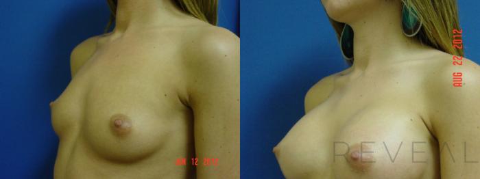 Before & After Breast Augmentation Case 88 View #2 View in San Jose, CA