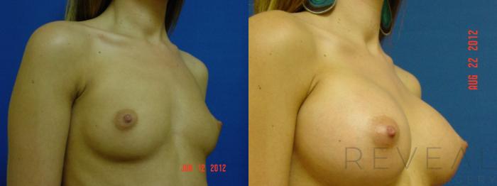 Before & After Breast Augmentation Case 88 View #3 View in San Jose, CA