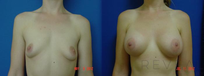 Before & After Breast Augmentation Case 89 View #1 View in San Jose, CA