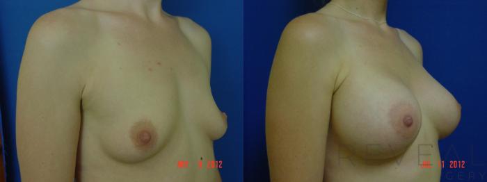 Before & After Breast Augmentation Case 89 View #2 View in San Jose, CA