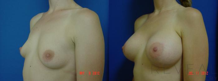 Before & After Breast Augmentation Case 89 View #3 View in San Jose, CA