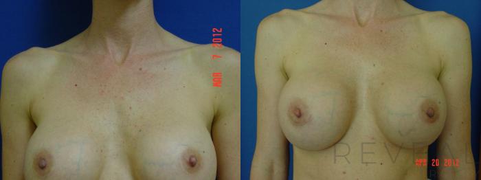 Before & After Breast Augmentation Case 92 View #1 View in San Jose, CA