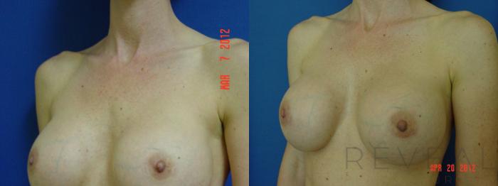 Before & After Breast Augmentation Case 92 View #2 View in San Jose, CA