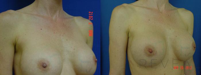 Before & After Breast Augmentation Case 92 View #3 View in San Jose, CA