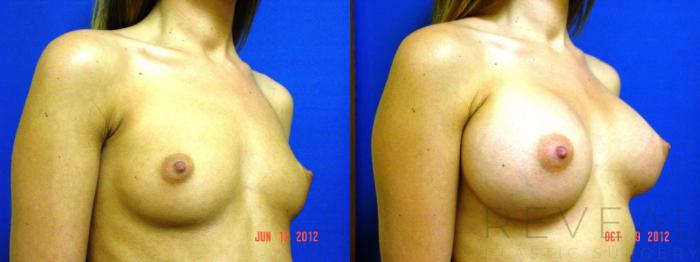 Before & After Breast Augmentation Case 95 View #1 View in San Jose, CA