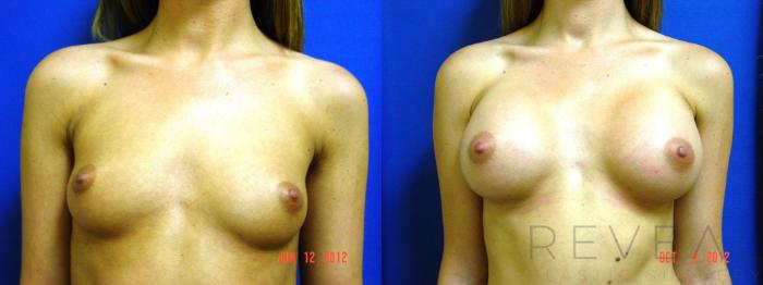 Before & After Breast Augmentation Case 95 View #2 View in San Jose, CA