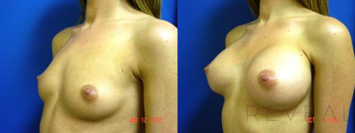 Before & After Breast Augmentation Case 95 View #3 View in San Jose, CA